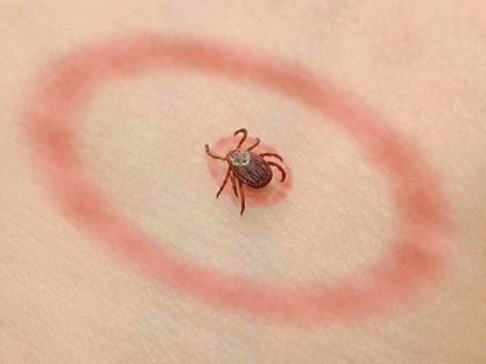 Borrelioz