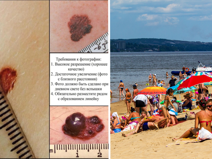 родинки